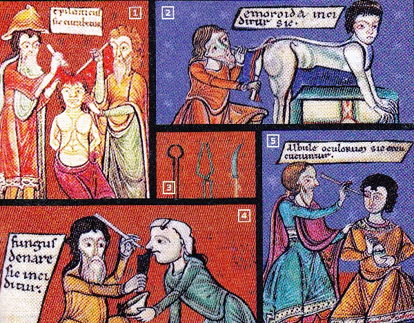 Средневековые хирургические техники